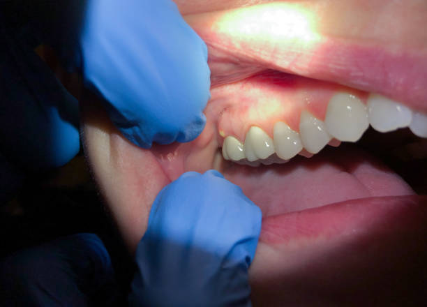 Best Chipped Tooth Repair Near Me  in Absecon Highlands, NJ